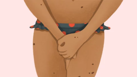 Ilustración de una mujer sufriendo candidiasis en verano