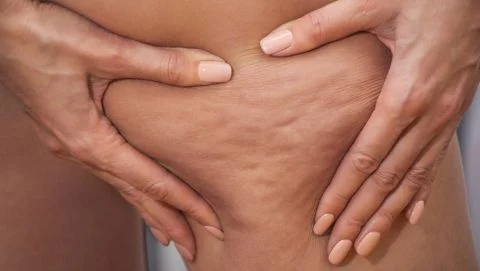 celulitis blanda y celulitis dura causas